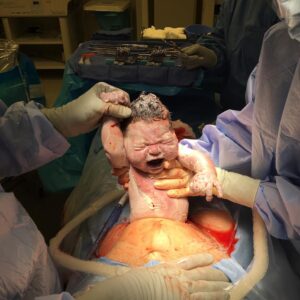 Pregnancy and Birth with Type 1 Diabetes