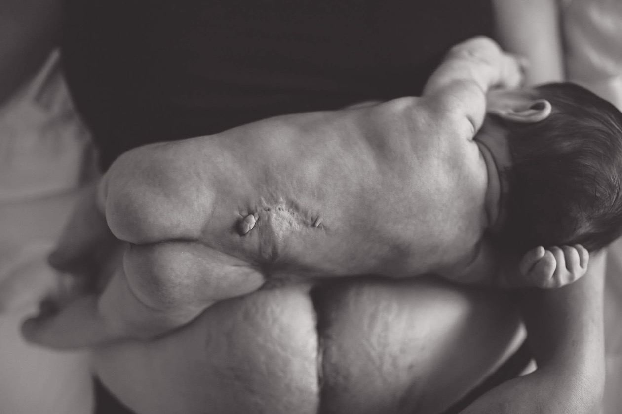 Spina Bifada and Successful Fetal Surgery