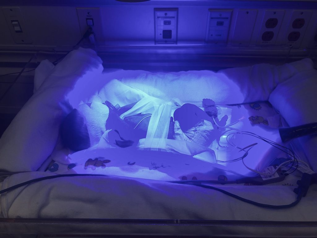 jaundice nicu stay