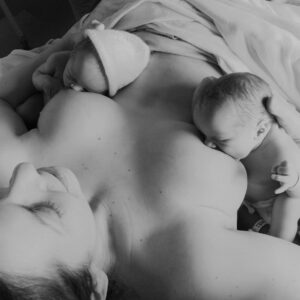 Vasectomy Reversal, IVF Twins, & Planned Cesarean under General Anesthesia