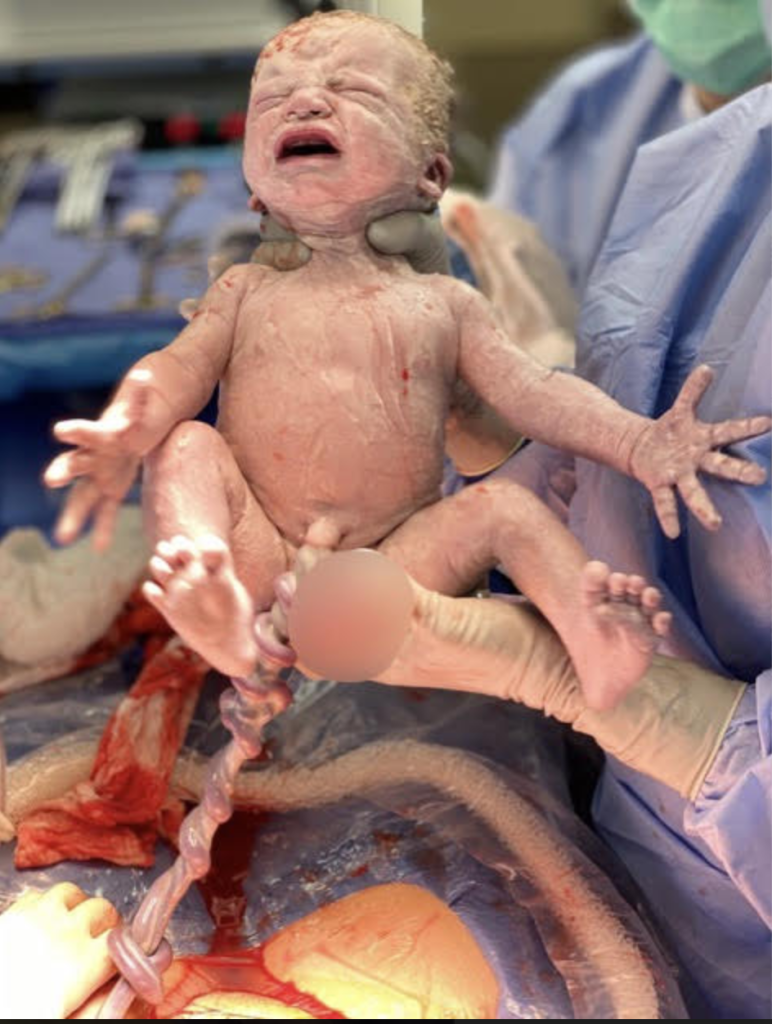 true-knot-cesarean