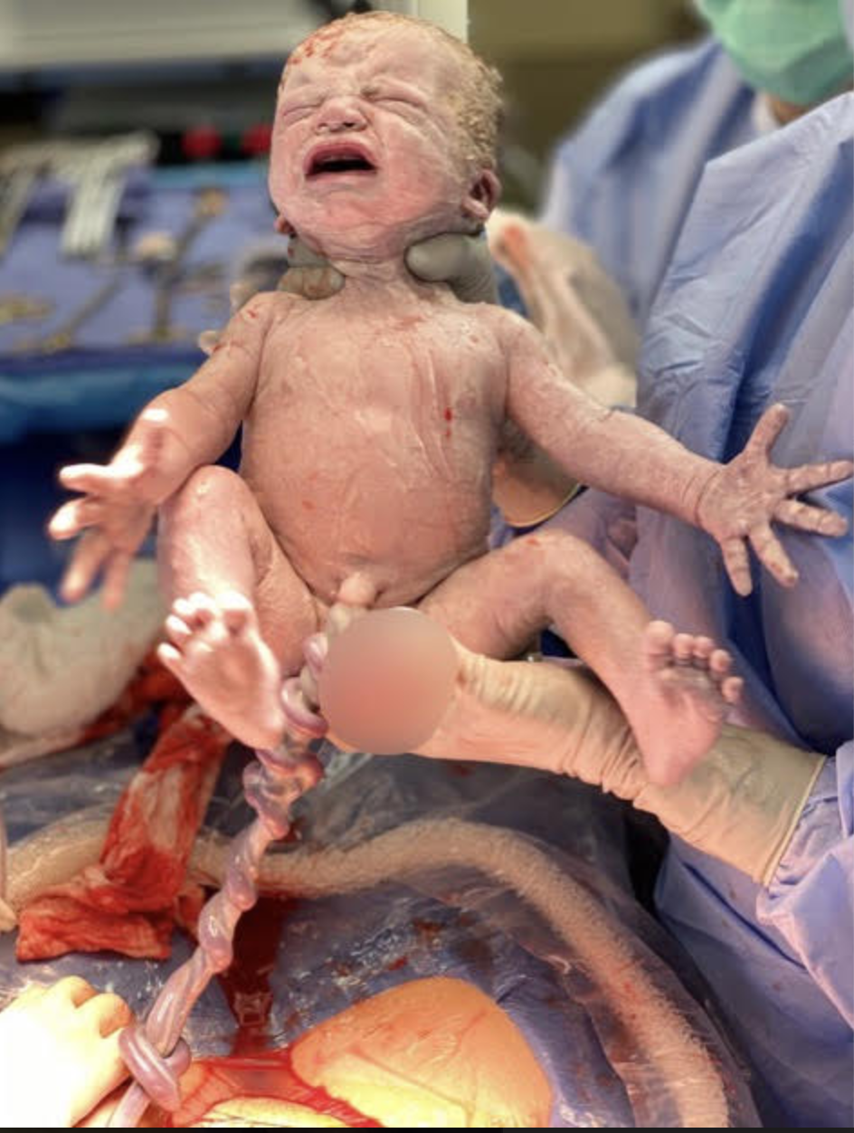 Four Hyperemesis Gravidarum (HG) Pregnancies & COVID-19 NICU Experience