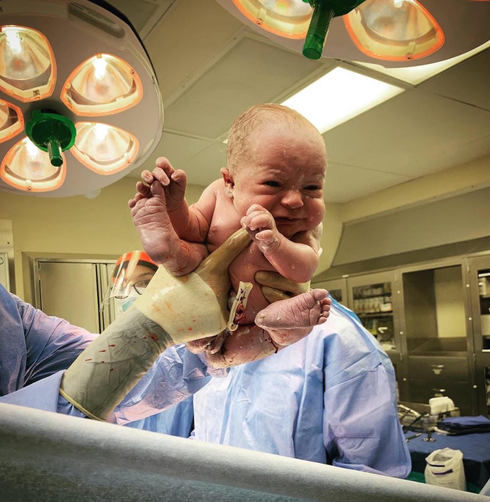 cesarean birth after ECV