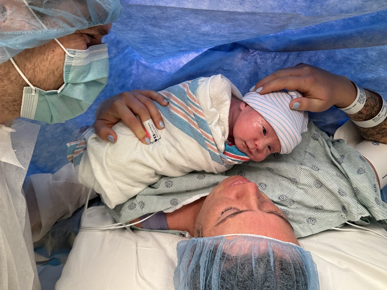 Positive Unplanned Cesarean Birth after Successful ECV