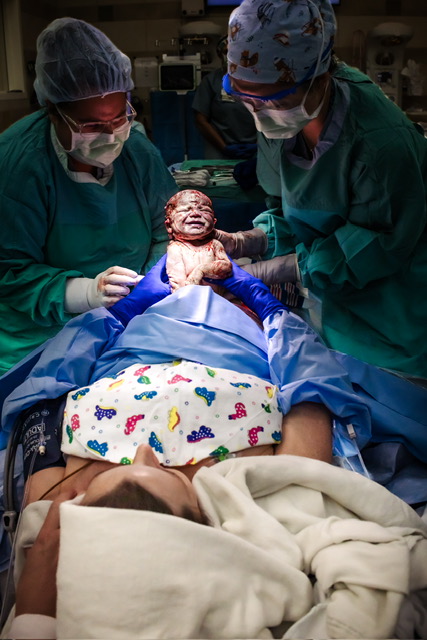 Redemptive Maternal Assisted Cesarean Birth after Profound Incontinence Following Vaginal Birth