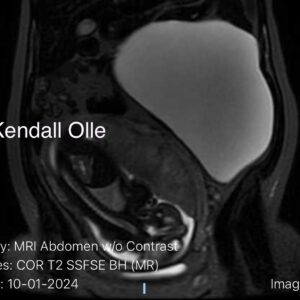 Pregnant with Extremely Large Ovarian Cyst, Cesarean Birth with Removal of Ovary